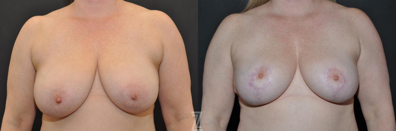 Austin Breast Reduction Before & After Gallery - Patient 132886615 - Image 1 - The Piazza Center