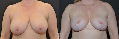 Breast Reduction Before & After Gallery - Patient 132886615 - Image 1