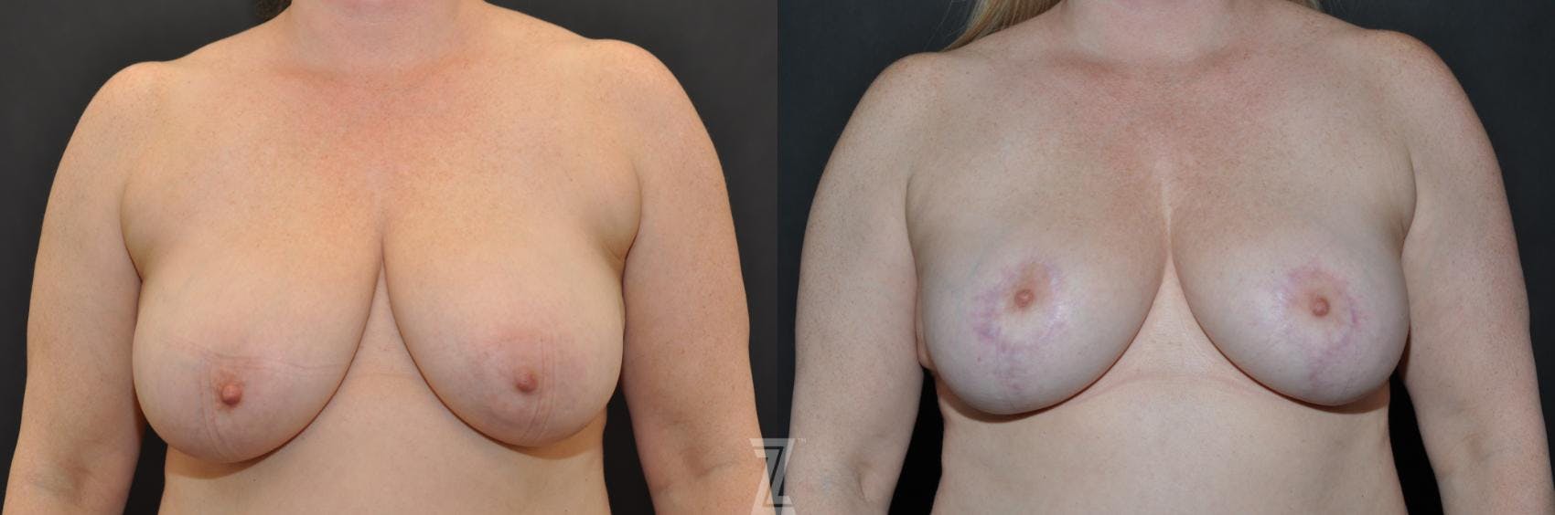 Breast Reduction Before & After Gallery - Patient 132886615 - Image 1