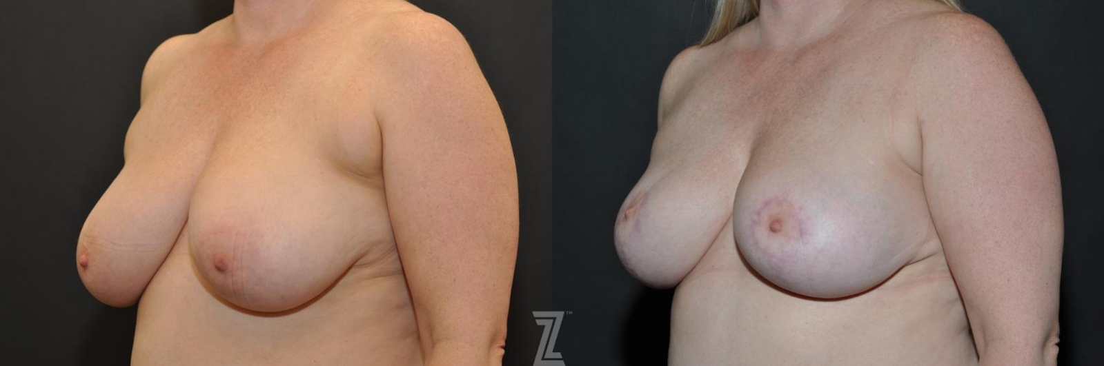 Austin Breast Reduction Before & After Gallery - Patient 132886615 - Image 2 - The Piazza Center