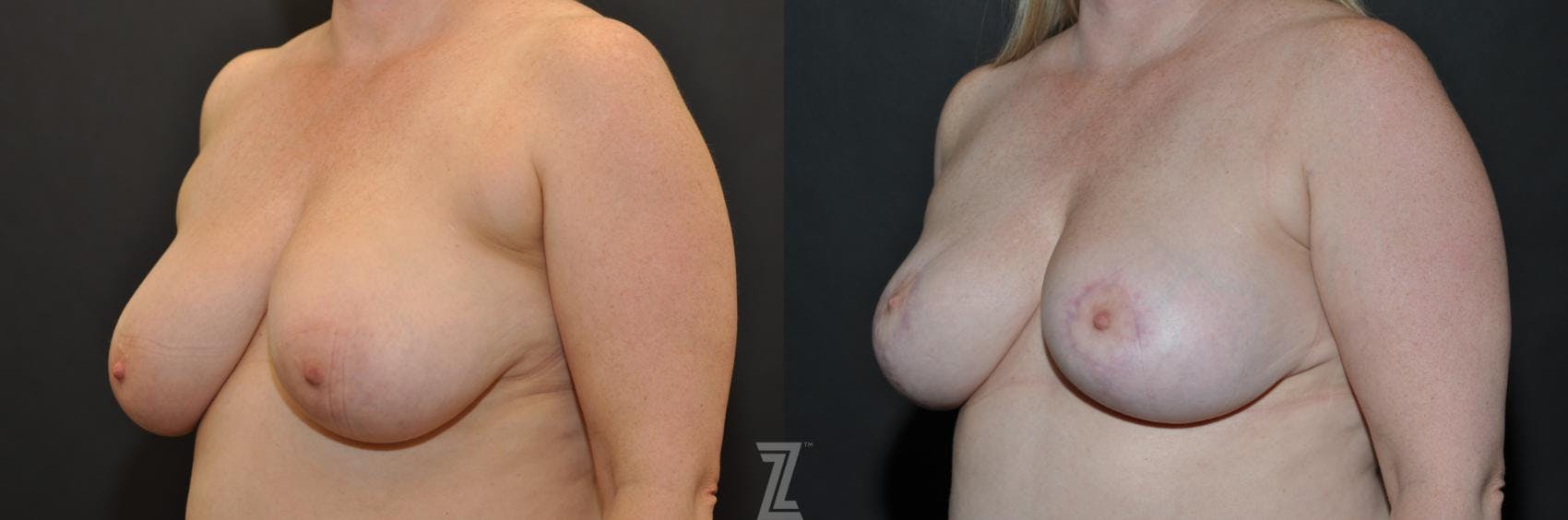 Breast Reduction Before & After Gallery - Patient 132886615 - Image 2
