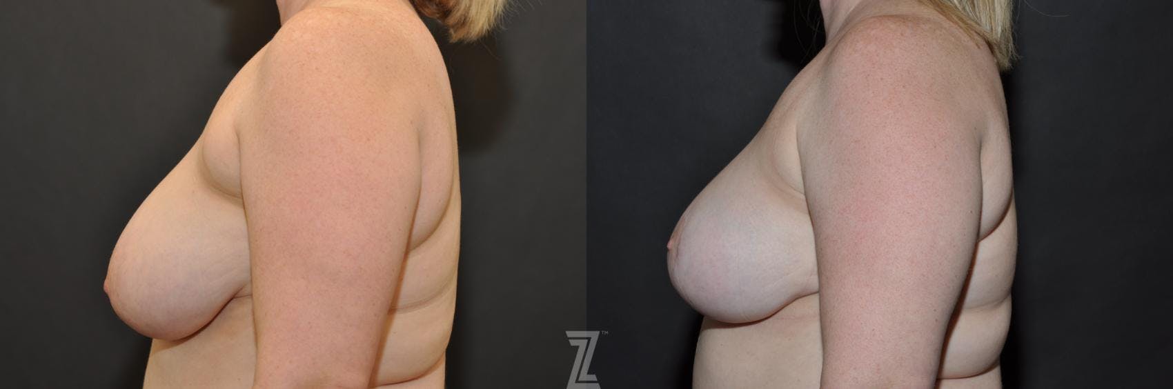Breast Reduction Before & After Gallery - Patient 132886615 - Image 3