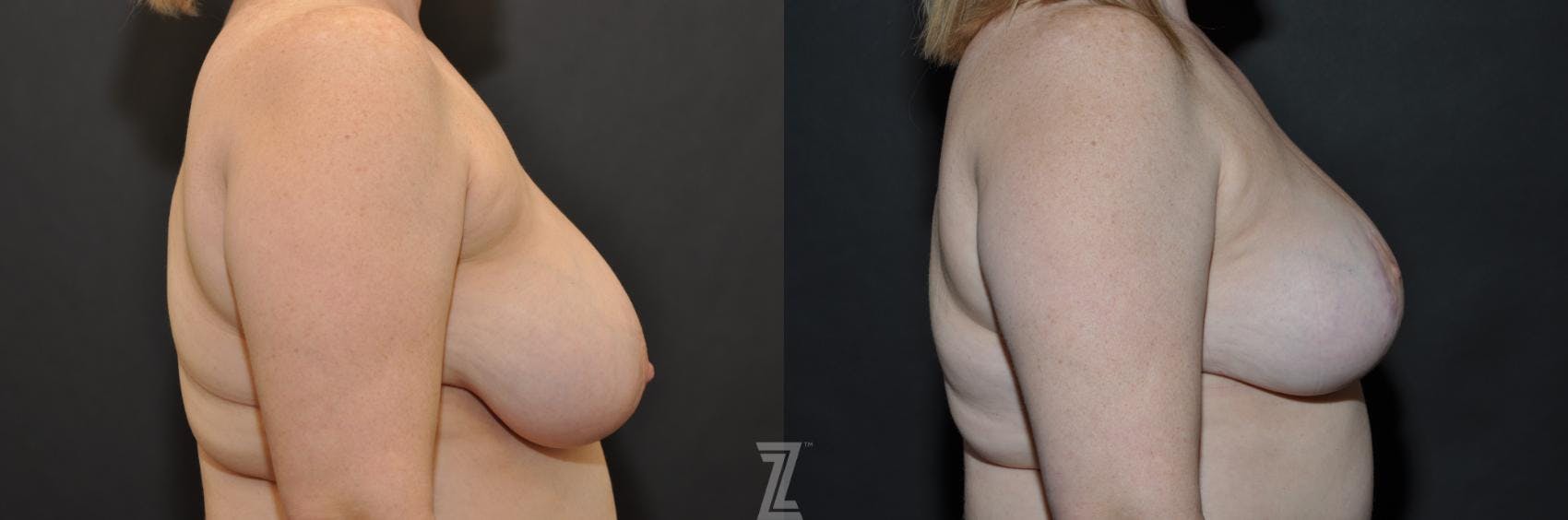 Breast Reduction Before & After Gallery - Patient 132886615 - Image 5