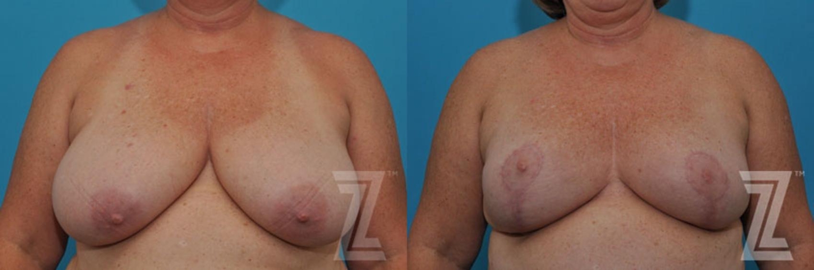 Austin Breast Reduction Before & After Gallery - Patient 132886617 - Image 1 - The Piazza Center