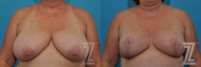 Breast Reduction Before & After Gallery - Patient 132886617 - Image 1