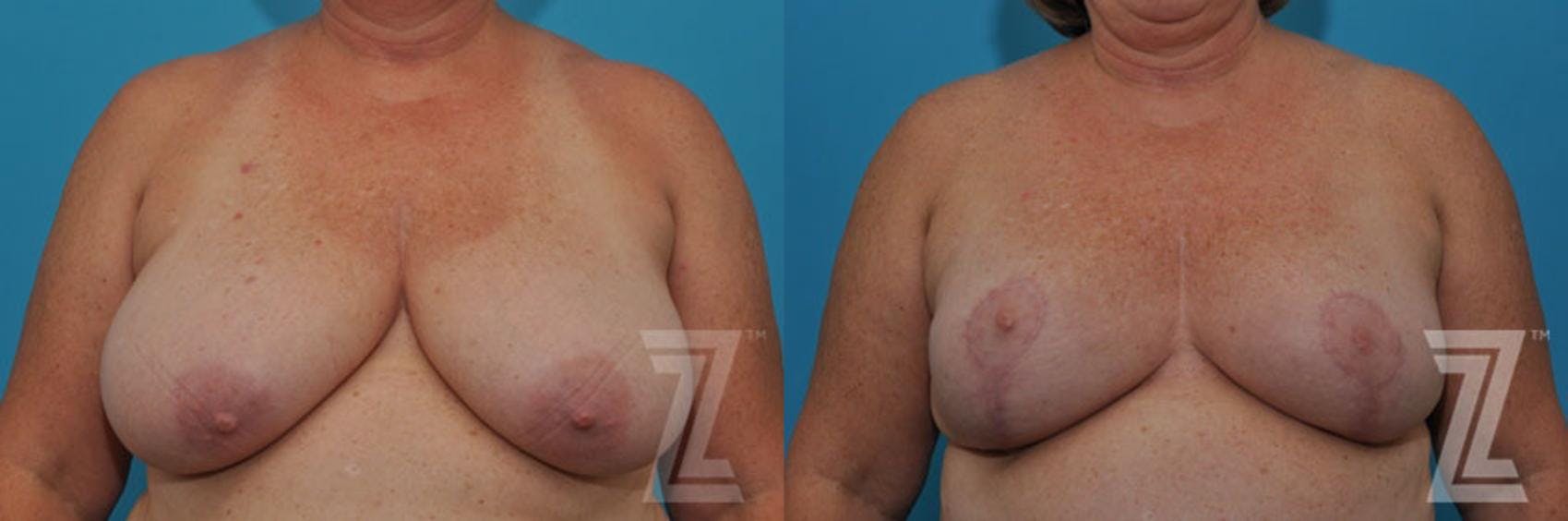 Breast Reduction Before & After Gallery - Patient 132886617 - Image 1