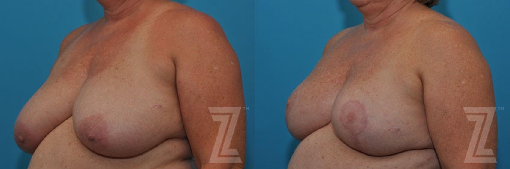 Breast Reduction Before & After Gallery - Patient 132886617 - Image 2