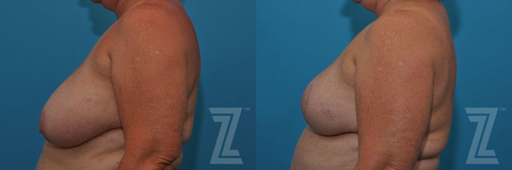 Breast Reduction Before & After Gallery - Patient 132886617 - Image 3