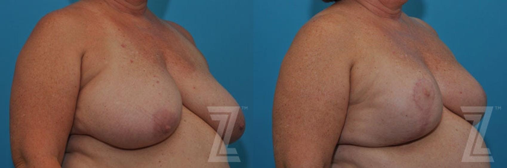 Breast Reduction Before & After Gallery - Patient 132886617 - Image 4