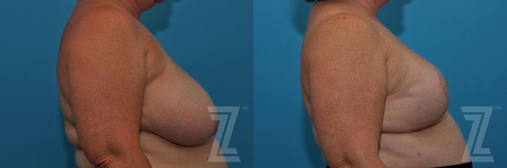 Breast Reduction Before & After Gallery - Patient 132886617 - Image 5
