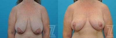 Breast Reduction Before & After Gallery - Patient 132886744 - Image 1