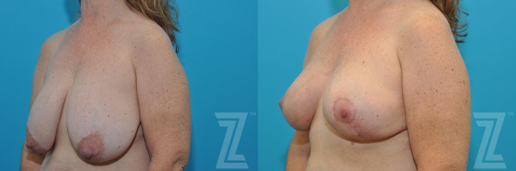 Breast Reduction Before & After Gallery - Patient 132886744 - Image 2