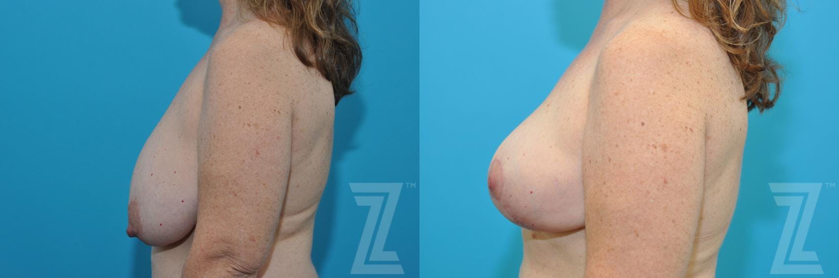 Breast Reduction Before & After Gallery - Patient 132886744 - Image 3