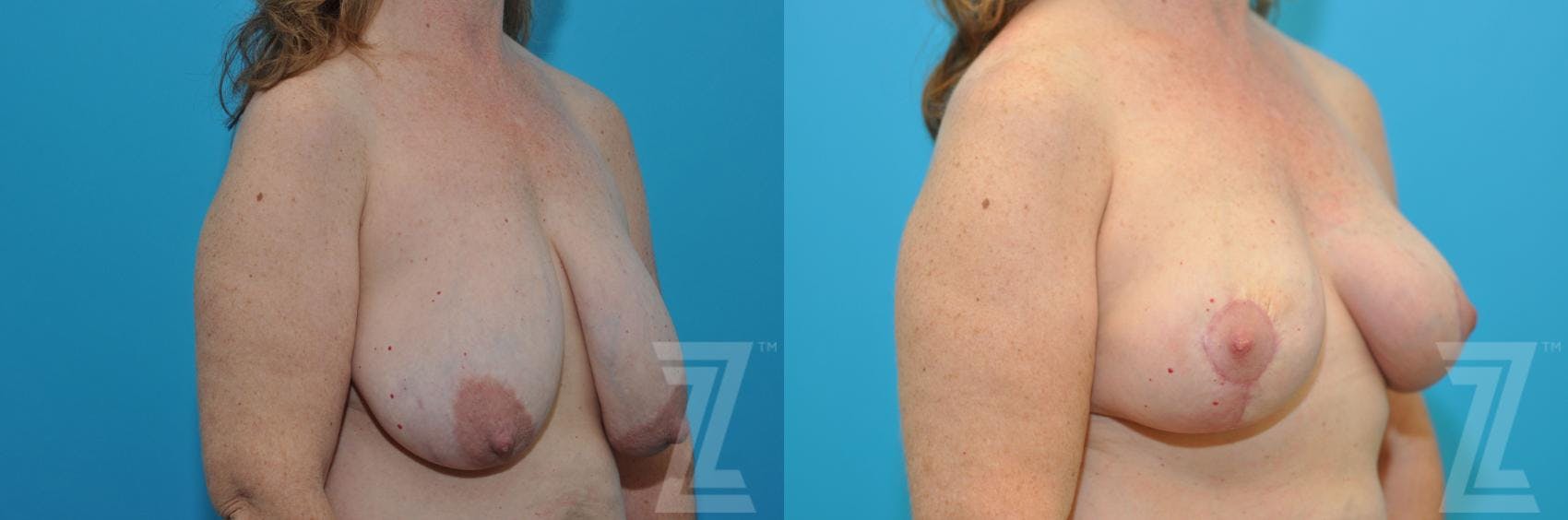 Breast Reduction Before & After Gallery - Patient 132886744 - Image 4