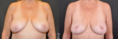 Austin Breast Reduction Before & After Gallery - Patient 132886745 - Image 1 - The Piazza Center