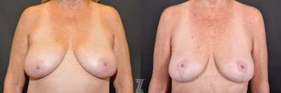 Breast Reduction Before & After Gallery - Patient 132886745 - Image 1