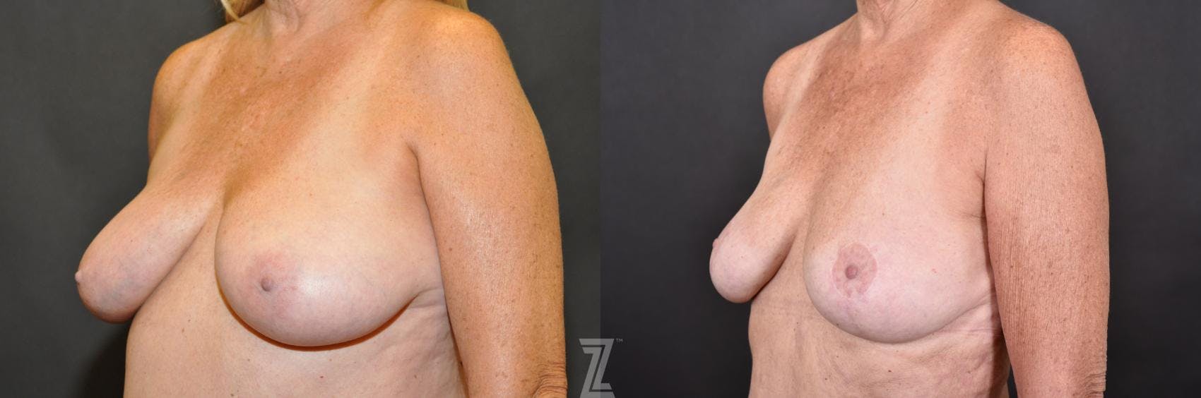 Breast Reduction Before & After Gallery - Patient 132886745 - Image 2