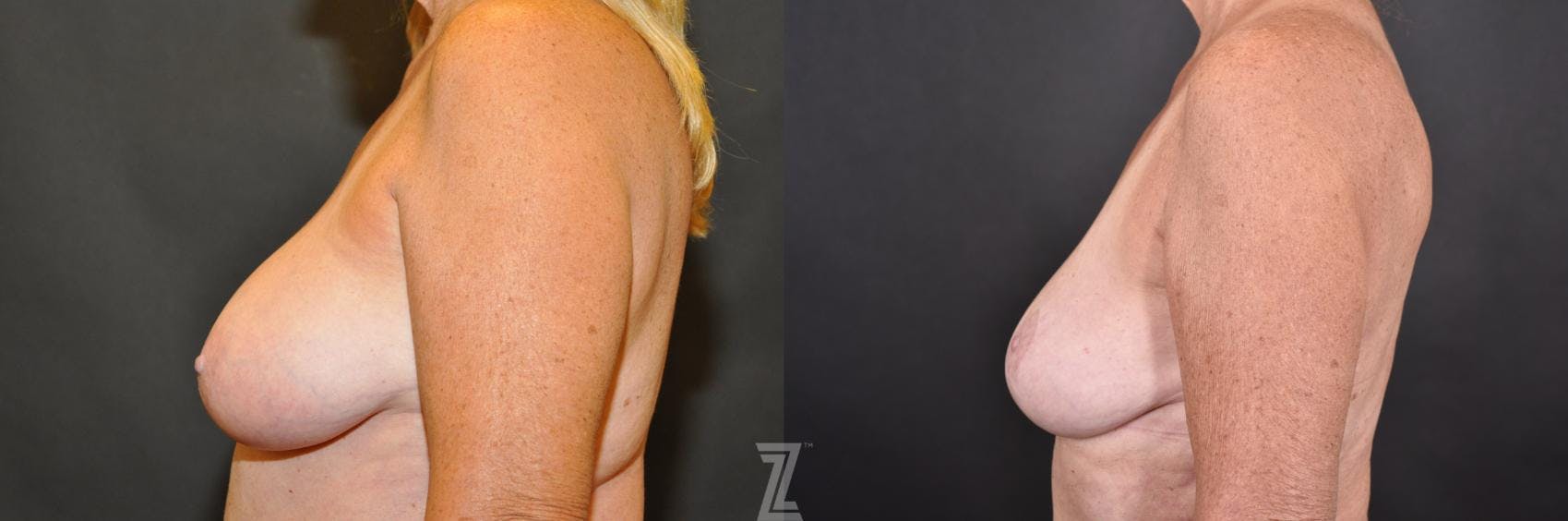Breast Reduction Before & After Gallery - Patient 132886745 - Image 3