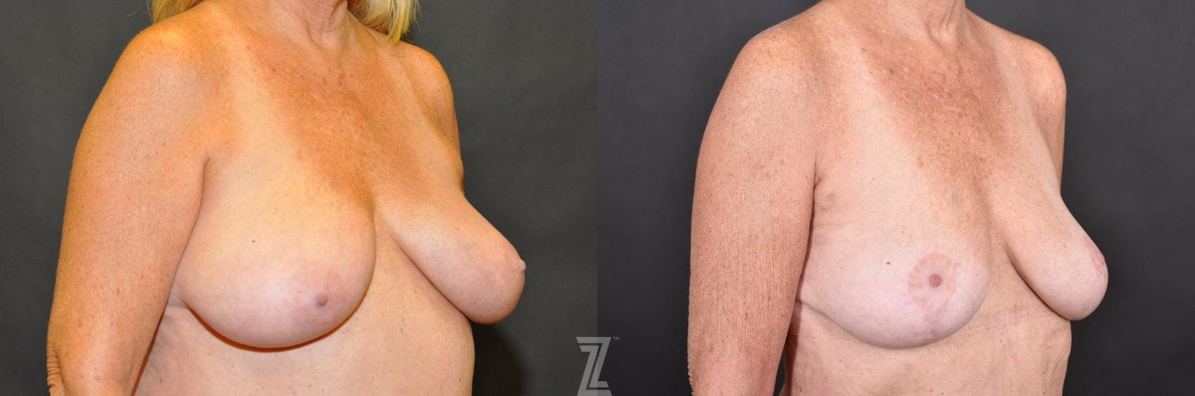 Breast Reduction Before & After Gallery - Patient 132886745 - Image 4