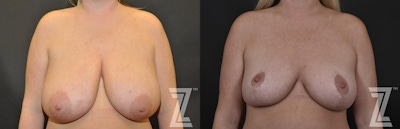Breast Reduction Before & After Gallery - Patient 132886746 - Image 1