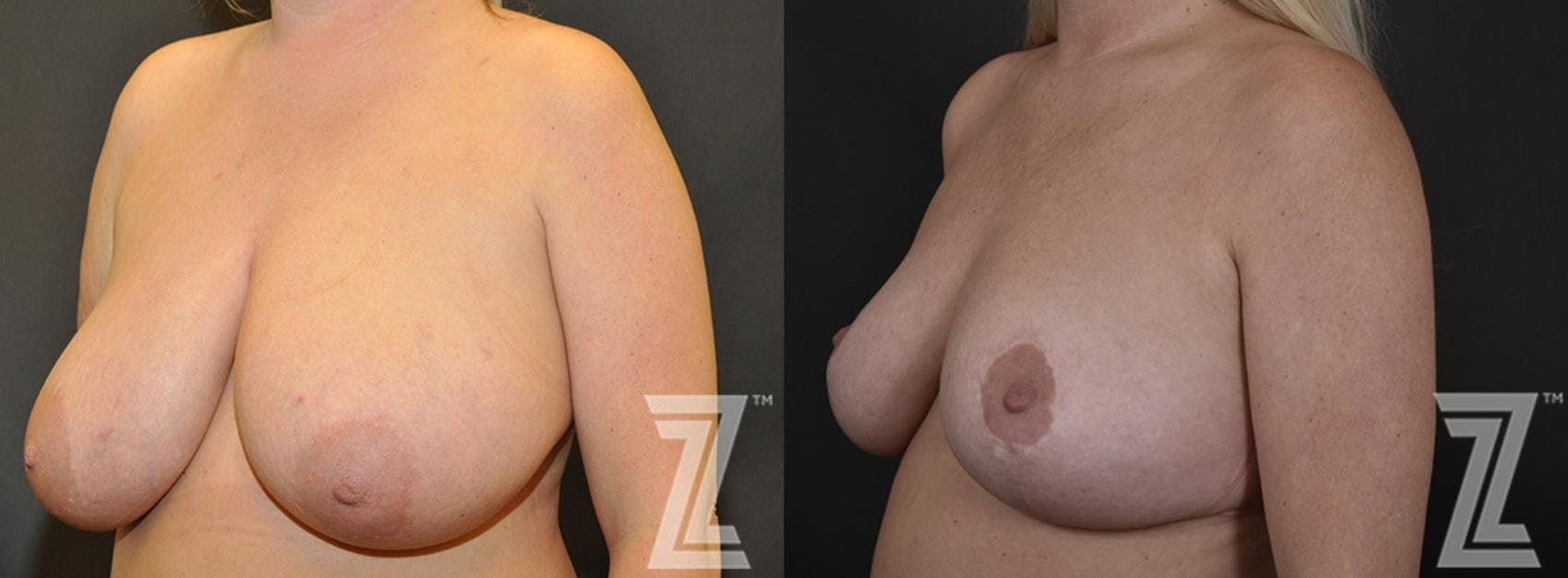 Breast Reduction Before & After Gallery - Patient 132886746 - Image 2