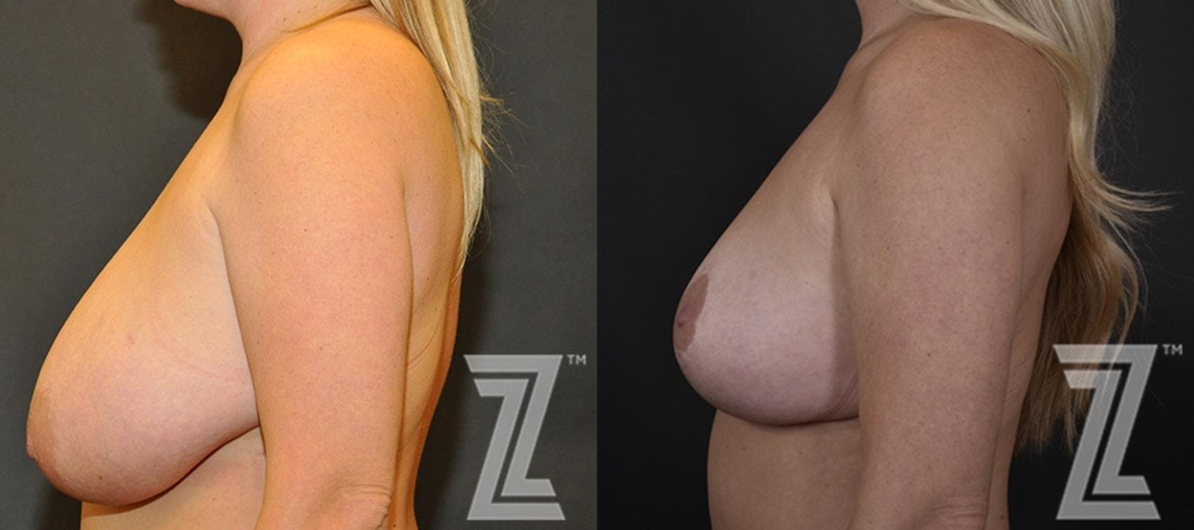 Breast Reduction Before & After Gallery - Patient 132886746 - Image 3
