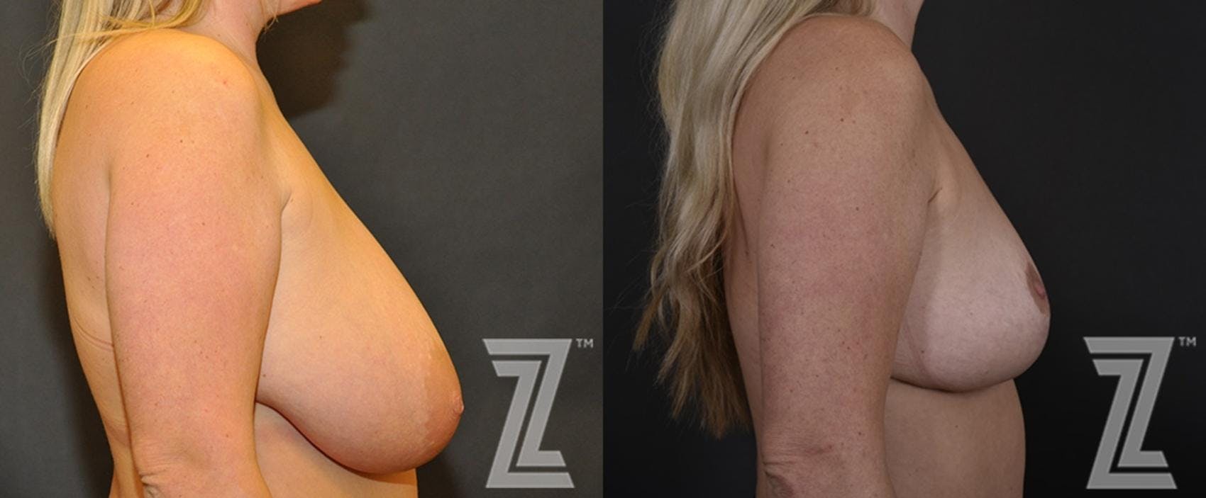 Breast Reduction Before & After Gallery - Patient 132886746 - Image 5