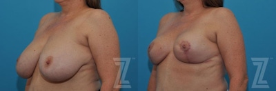Breast Reduction Before & After Gallery - Patient 132886747 - Image 1