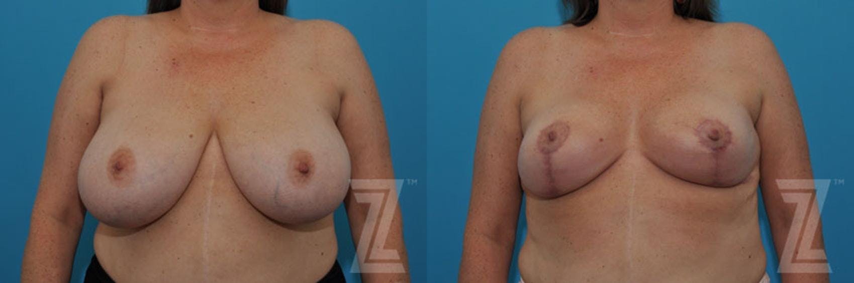 Breast Reduction Before & After Gallery - Patient 132886747 - Image 2