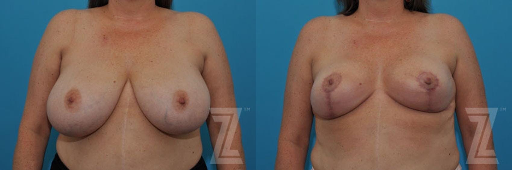 Breast Reduction Before & After Gallery - Patient 132886747 - Image 2
