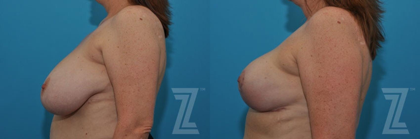 Breast Reduction Before & After Gallery - Patient 132886747 - Image 3