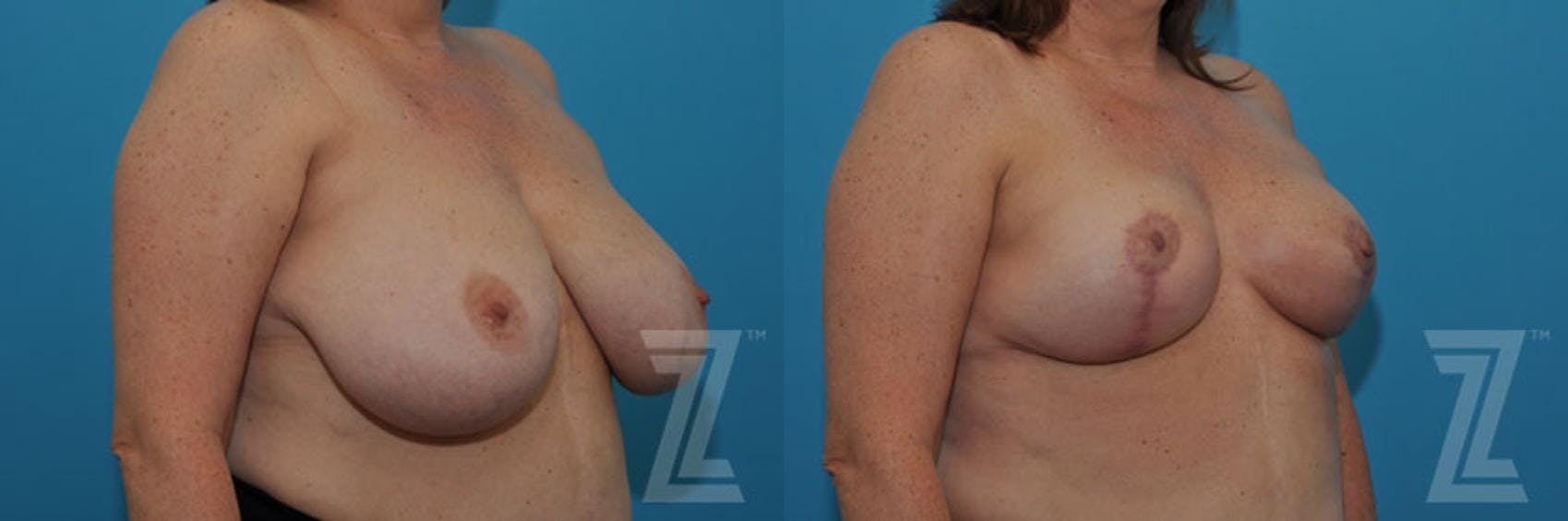Breast Reduction Before & After Gallery - Patient 132886747 - Image 4