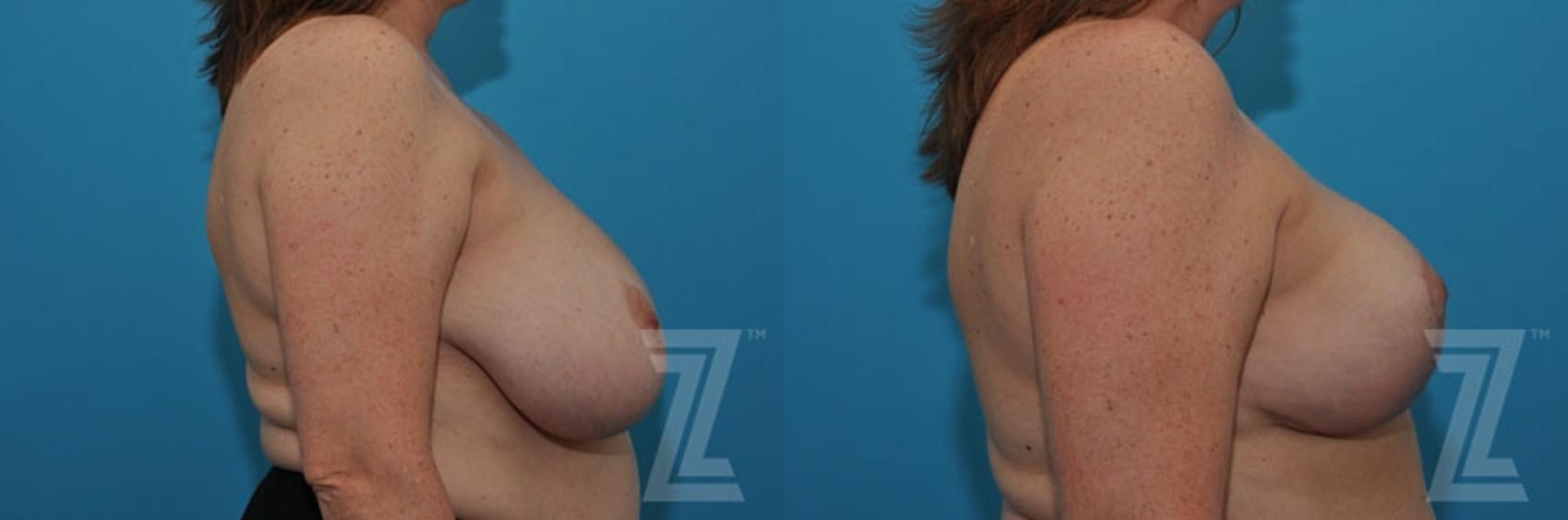 Austin Breast Reduction Before & After Gallery - Patient 132886747 - Image 5 - The Piazza Center