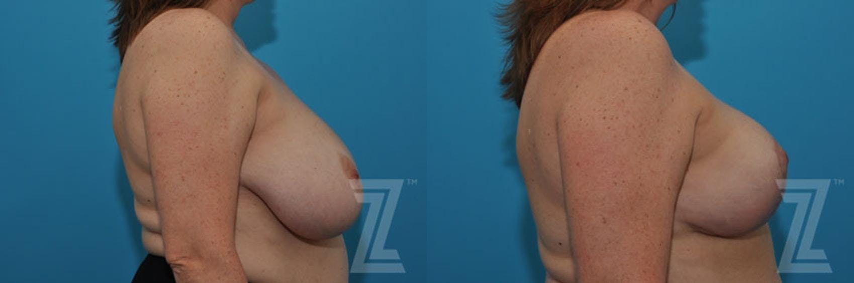 Breast Reduction Before & After Gallery - Patient 132886747 - Image 5