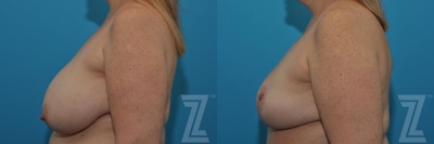 Breast Reduction Before & After Gallery - Patient 132886750 - Image 1