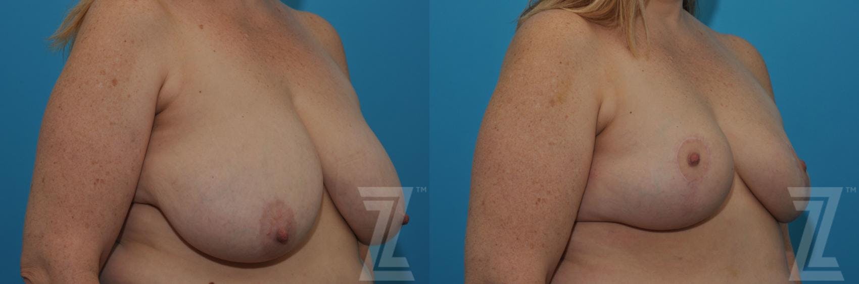 Breast Reduction Before & After Gallery - Patient 132886750 - Image 2