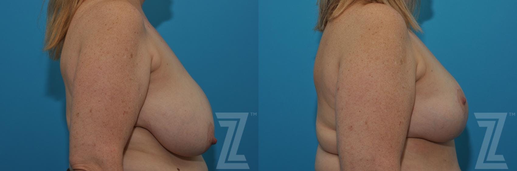 Breast Reduction Before & After Gallery - Patient 132886750 - Image 3