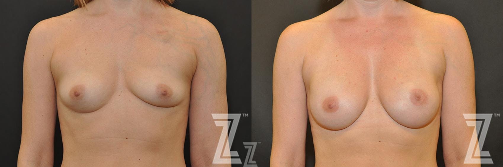 Breast Reconstruction Before & After Gallery - Patient 132886763 - Image 1