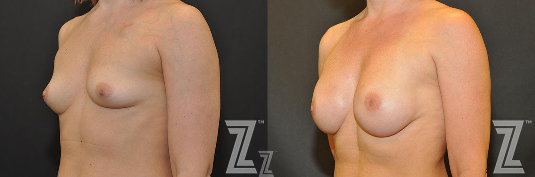 Breast Reconstruction Before & After Gallery - Patient 132886763 - Image 2