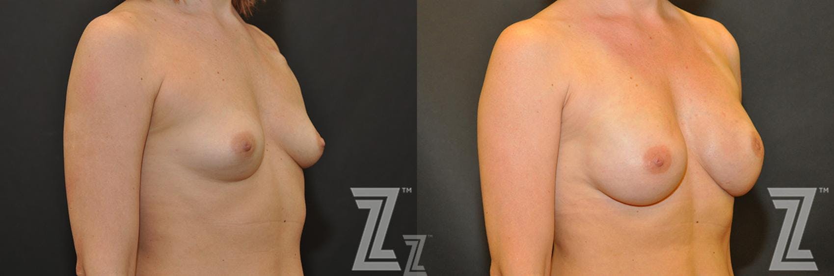 Breast Reconstruction Before & After Gallery - Patient 132886763 - Image 4