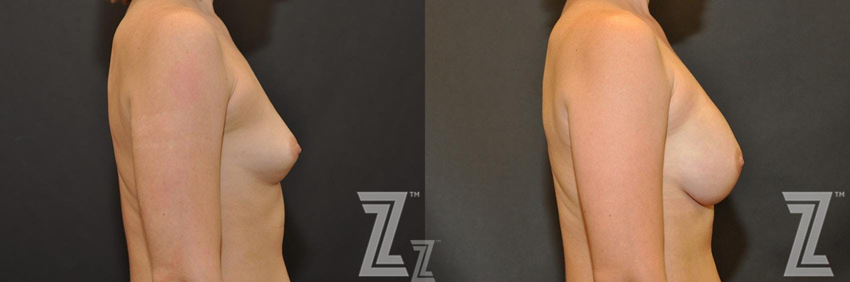 Breast Reconstruction Before & After Gallery - Patient 132886763 - Image 5