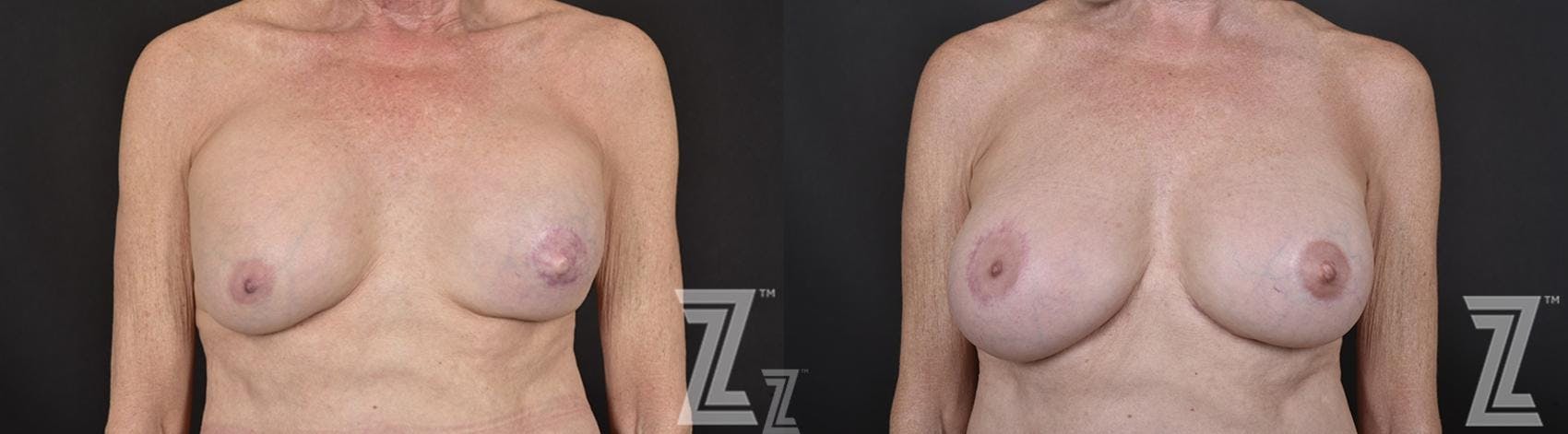 Breast Reconstruction Before & After Gallery - Patient 132886765 - Image 1