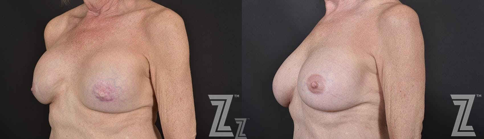 Breast Reconstruction Before & After Gallery - Patient 132886765 - Image 2