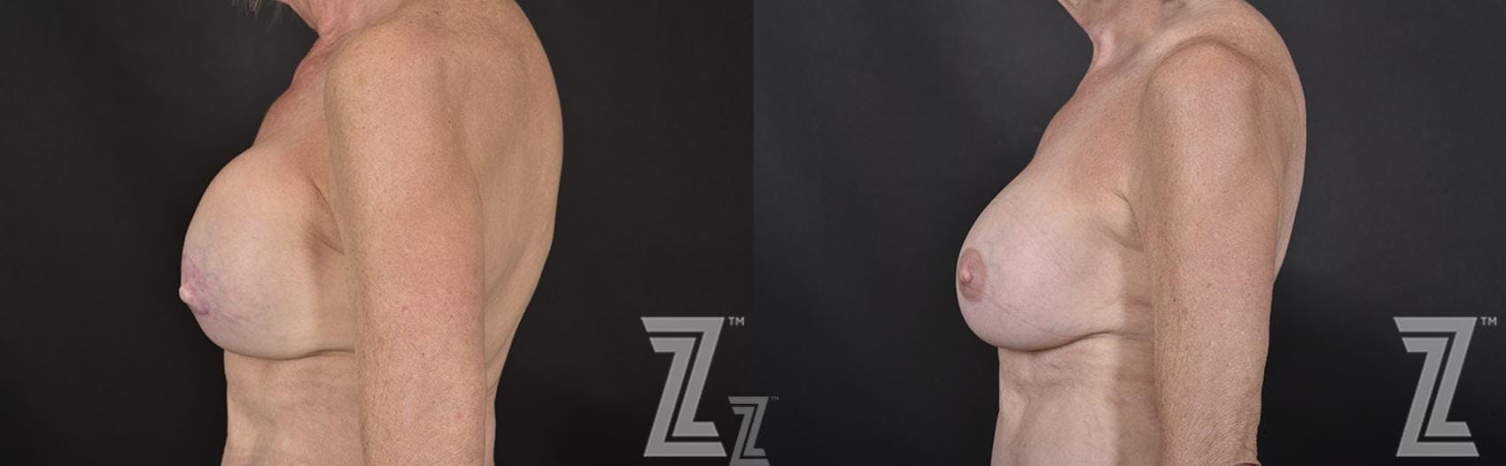 Breast Reconstruction Before & After Gallery - Patient 132886765 - Image 3