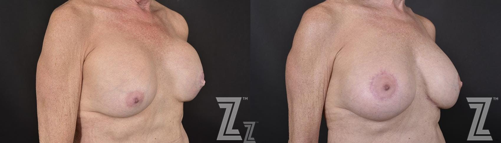Breast Reconstruction Before & After Gallery - Patient 132886765 - Image 4