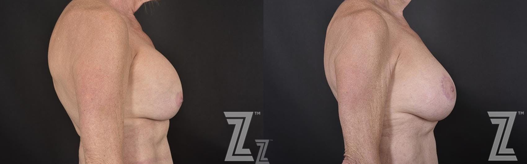 Breast Reconstruction Before & After Gallery - Patient 132886765 - Image 5