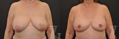 Austin Breast Reconstruction Before & After Gallery - Patient 132886766 - Image 1 - The Piazza Center