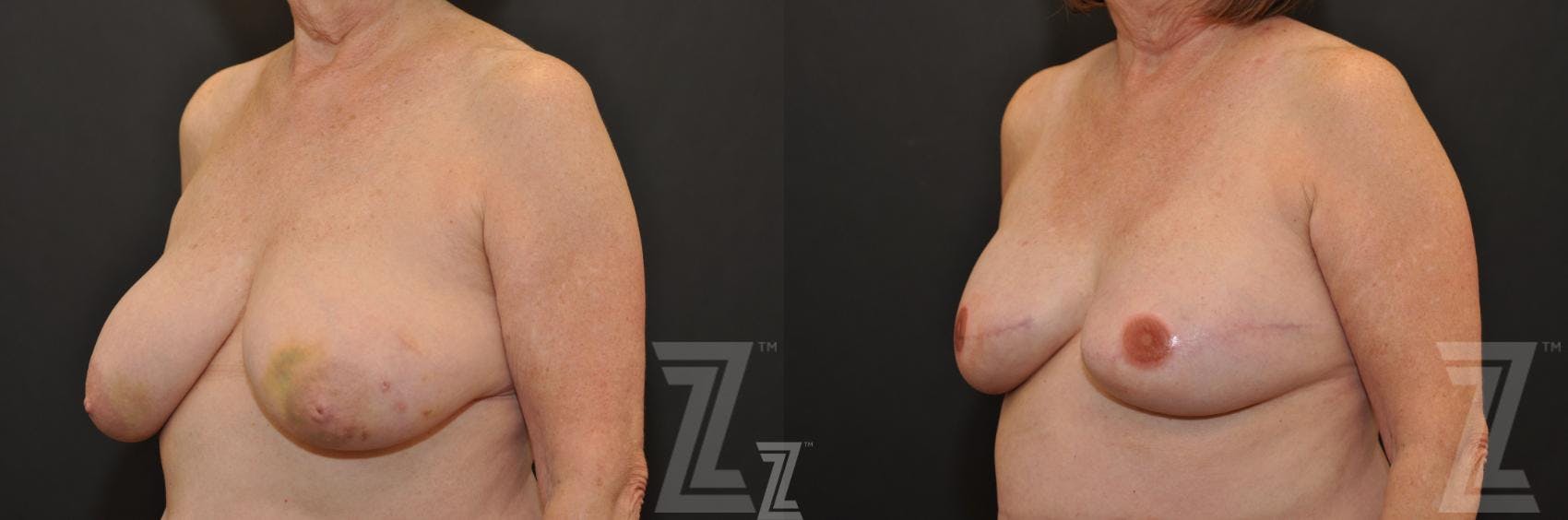Breast Reconstruction Before & After Gallery - Patient 132886766 - Image 2
