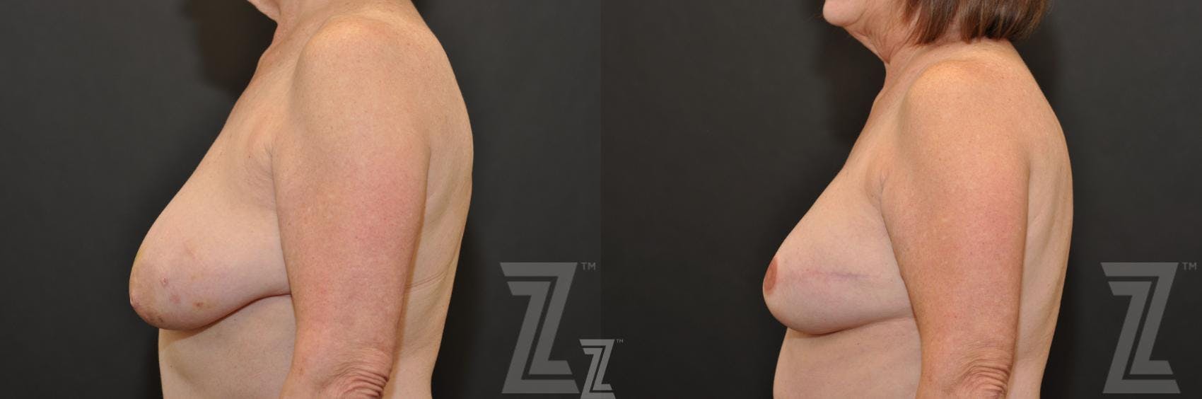 Breast Reconstruction Before & After Gallery - Patient 132886766 - Image 3