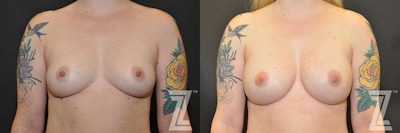 Breast Reconstruction Before & After Gallery - Patient 132886770 - Image 1